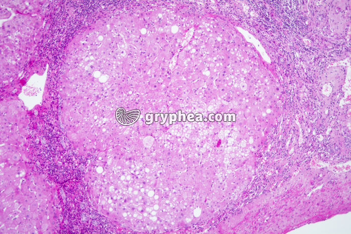 Foie pathologique x25 - gryphea.org